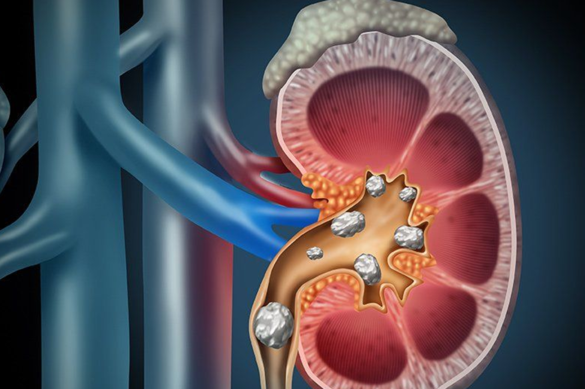 - Everything about kidney stones; From causes to new treatments - Dr. Boya