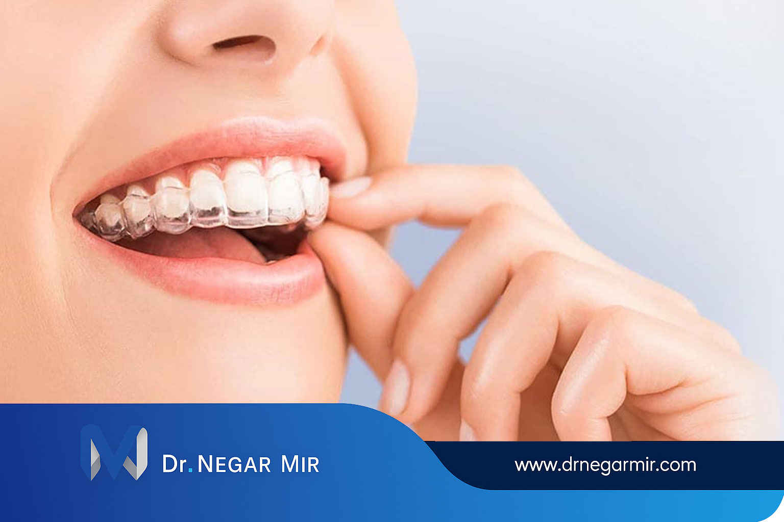 تقويم الأسنان الشفاف غير المرئي أو 1404 Invisalign