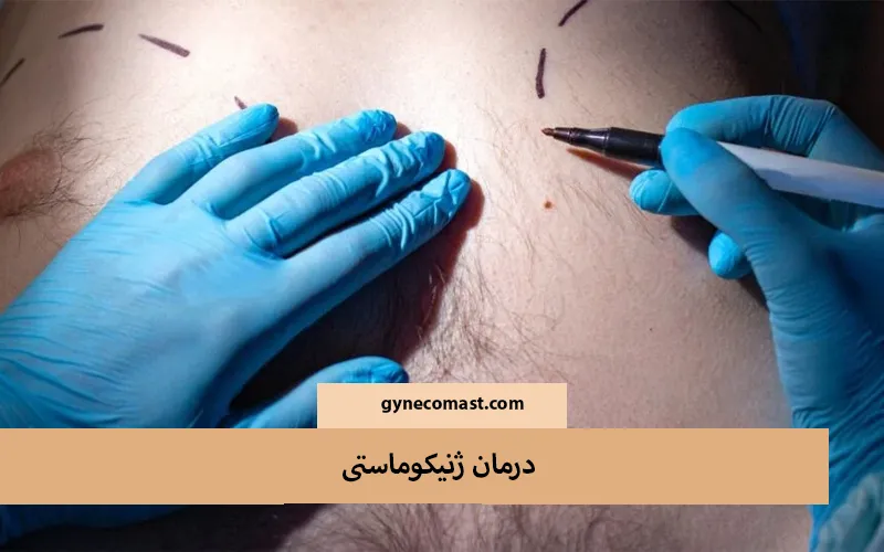 Treatment of gynecomastia