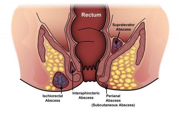 خراج الشرج وعلاجه - دكتور كرامتي أخصائي جراحة القولون - أفضل جراح البواسير