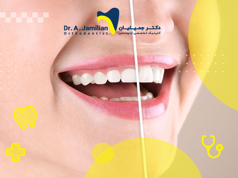 What is a gum lift and what are its benefits? - Dr. Jamilian