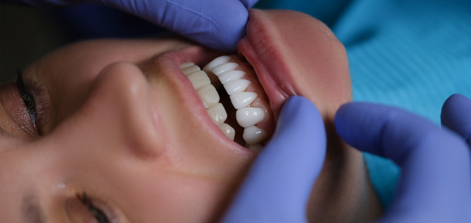 Care after dental composite