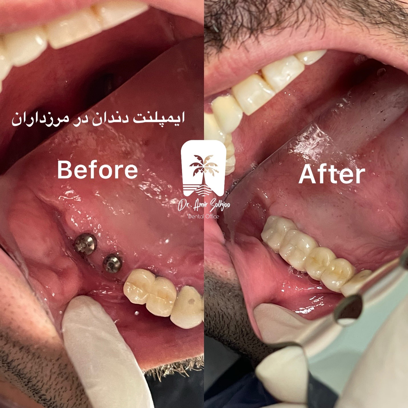 قیمت پوشش ایمپلنت 1404: تجزیه و تحلیل هزینه و انتخاب بهترین نوع