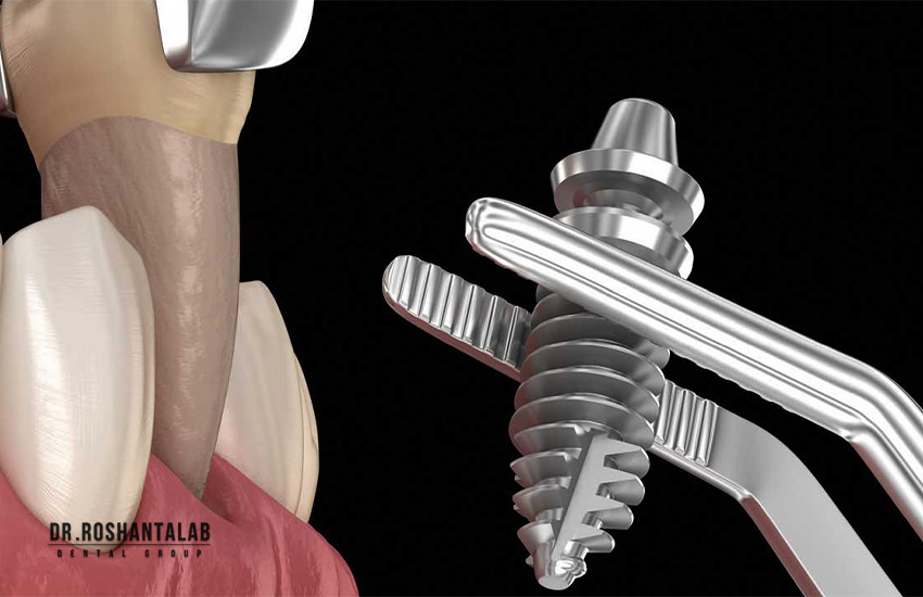 انواع ایمپلنت فوری دندان: 1 روزه یا 1 ماهه؟