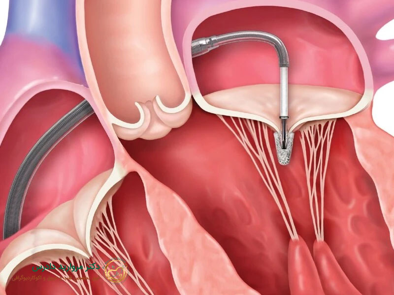 هل فشل صمام القلب ثلاثي الشرفات خطير؟ - د. مارفاريد دادرس