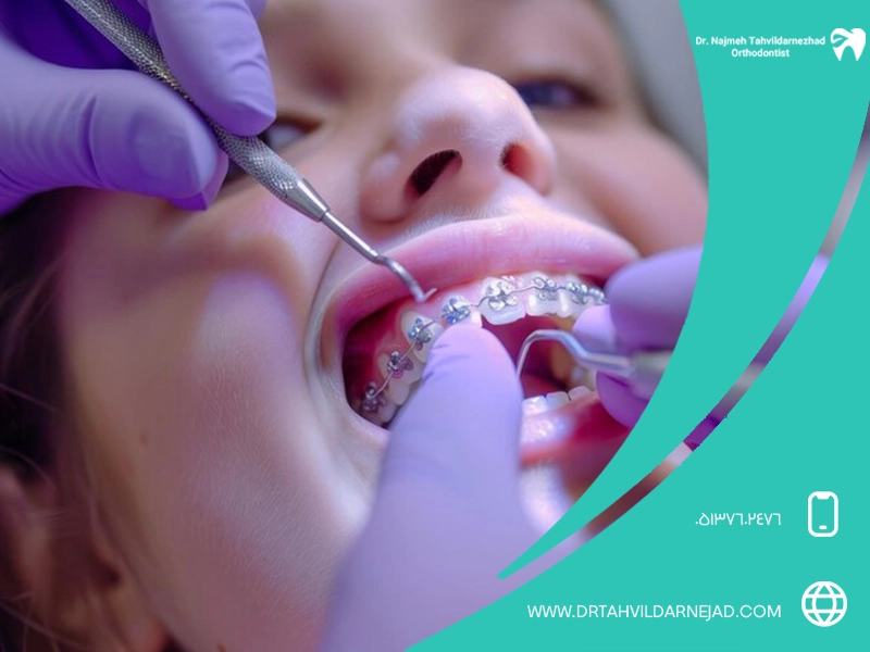 Getting to know the reasons and solutions to prevent the orthodontic bracket from coming off