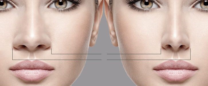 انواع تورم بینی بعد از جراحی