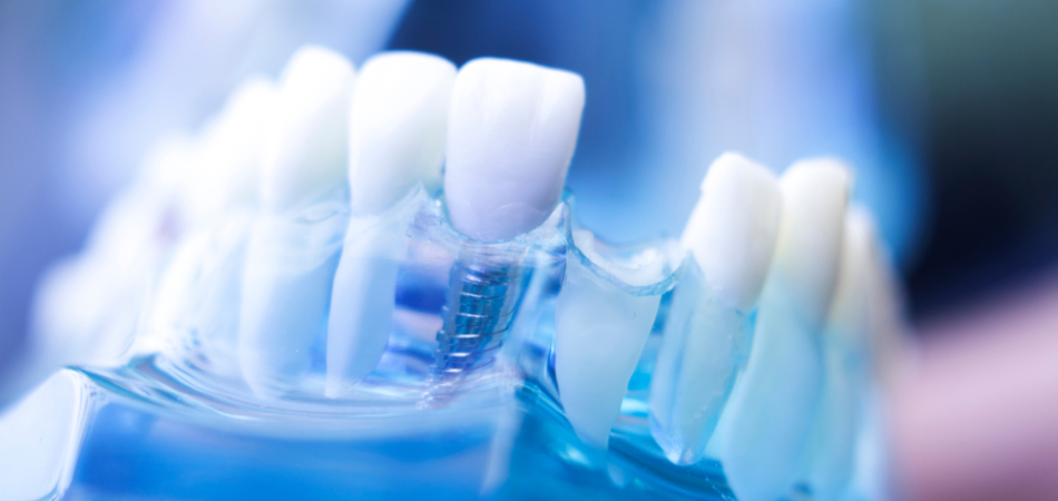 What is a front tooth implant? Full guide + price