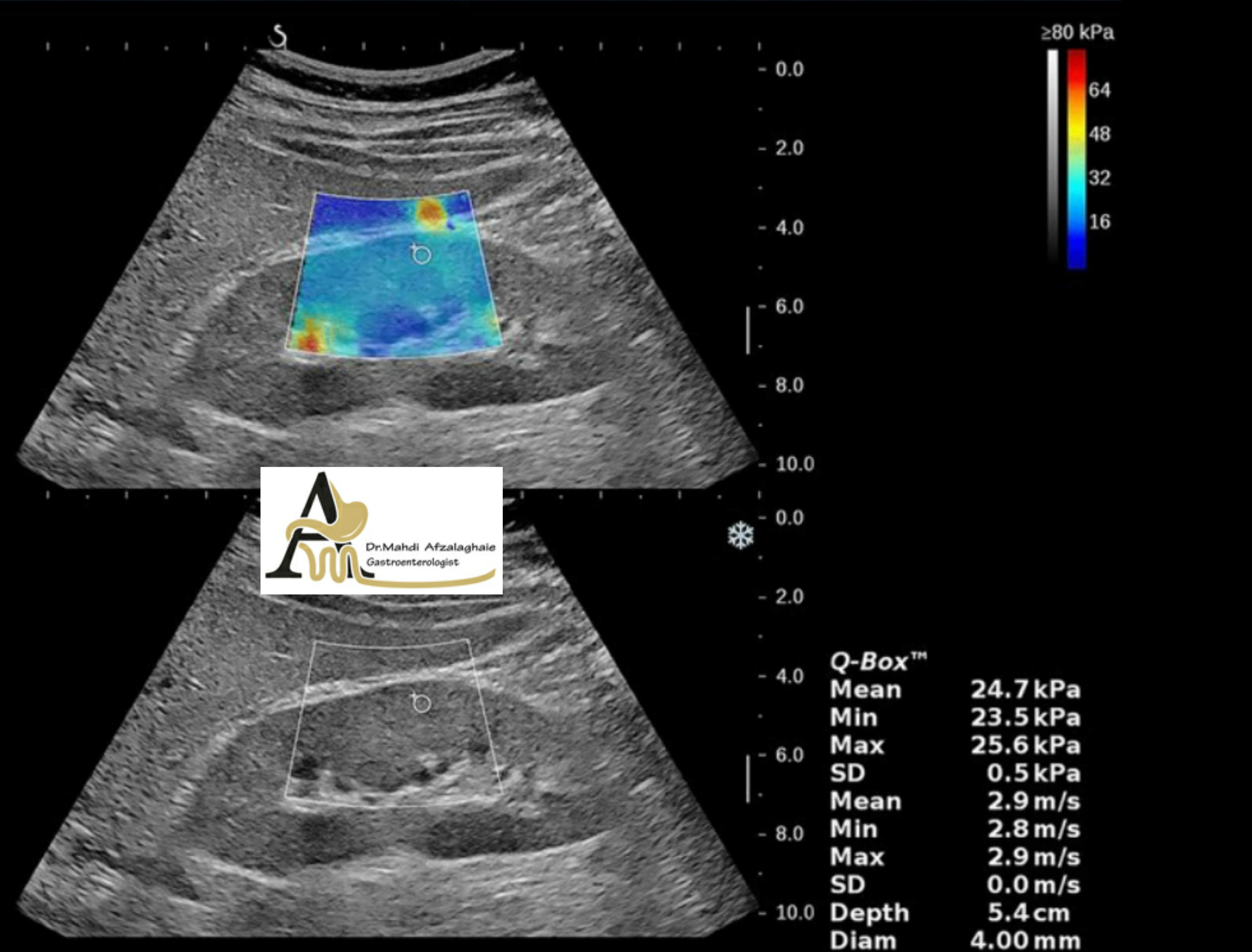 Liver elastography - gastroenterologist in Mashhad Dr. Mehdi Afzal Aghaei