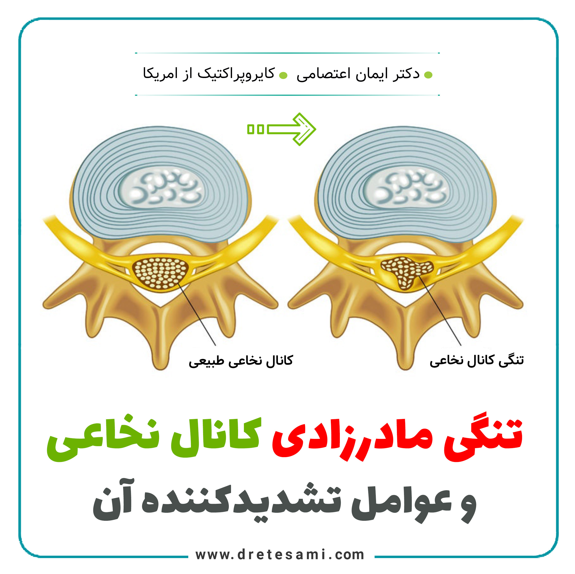 Congenital stenosis of the spinal canal