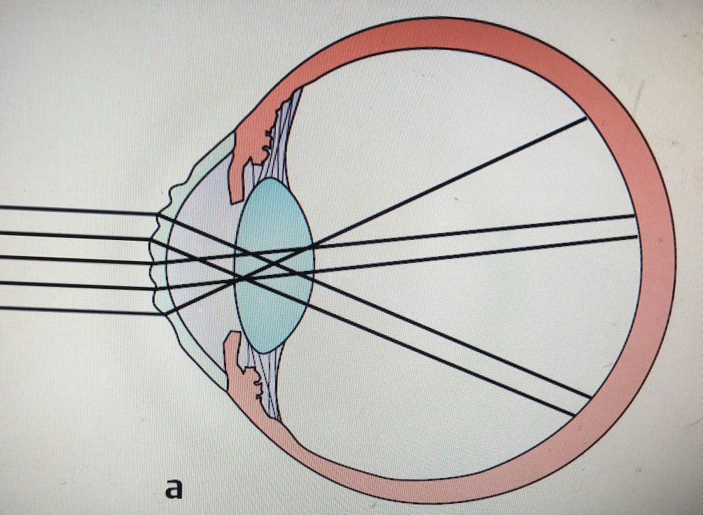 آستیگماتیسم