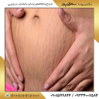 افتادگی رحم بعد از زایمان دکتر بیتا سجادی پور