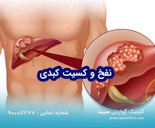 آیا کیست کبد می تواند باعث نفخ و مشکلات گوارشی شود؟