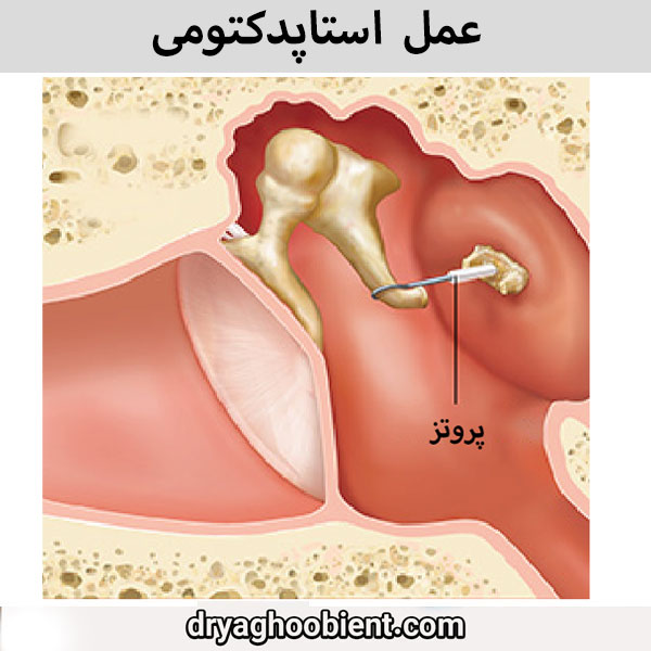 Ear stapedectomy Definitive treatment of otosclerosis and return of hearing
