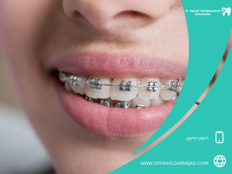 Introduction of treatment methods for mouth ulcers caused by orthodontic brackets Dr. Najmeh Tadredaranjad