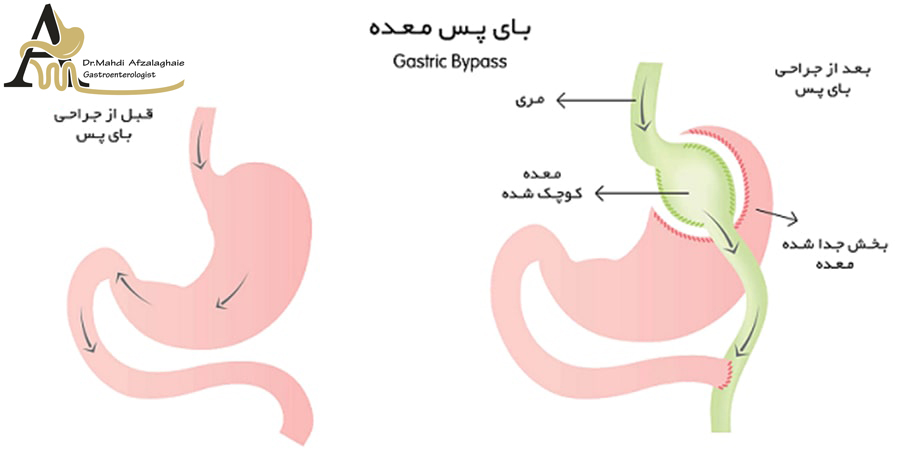 Gastric bypass operation - gastroenterologist in Mashhad Dr. Mehdi Afzal Aghaei