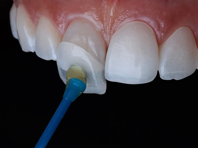 هزینه کامپوزیت دندان در سال 1404