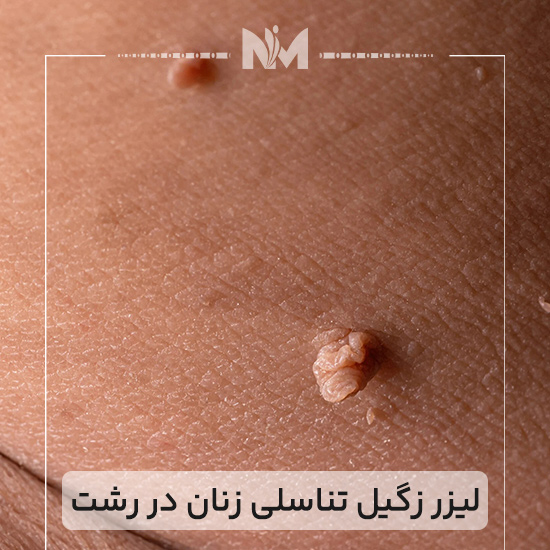 لیزر زگیل تناسلی زنان در رشت درمان سریع و بدون درد