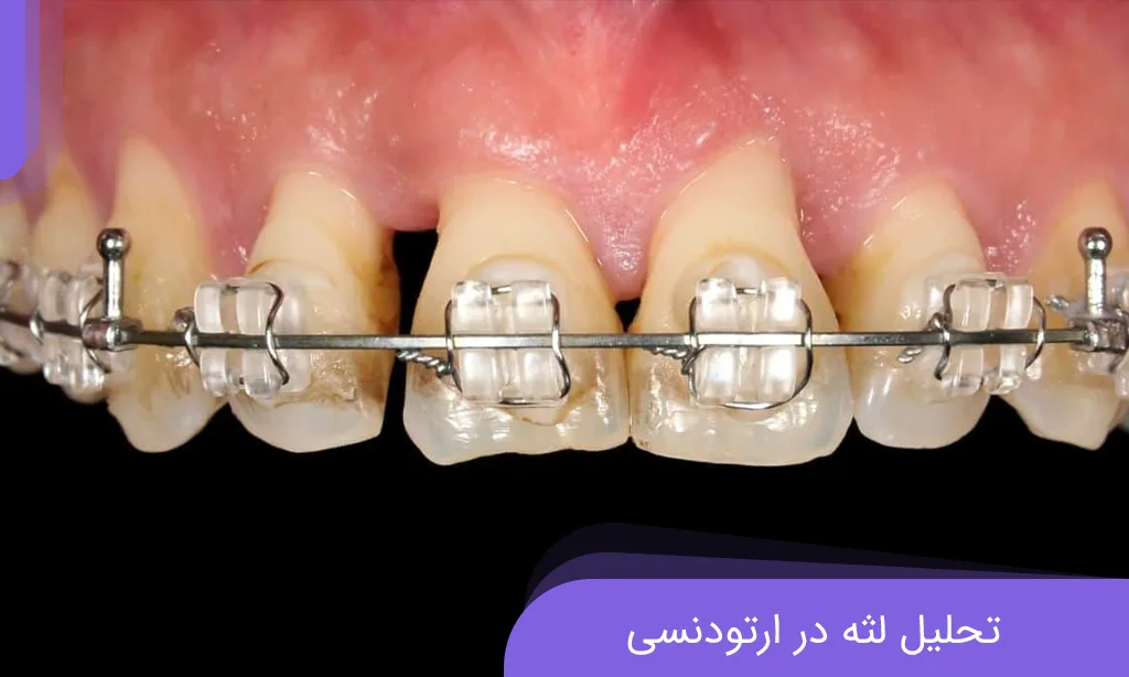 علائم تحلیل لثه در ارتودنسی و روش های جلوگیری از آن | دکتر خدوی