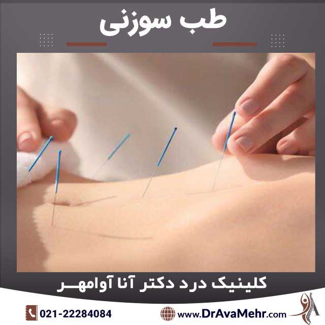 What is acupuncture and what is its use? Benefits, complications