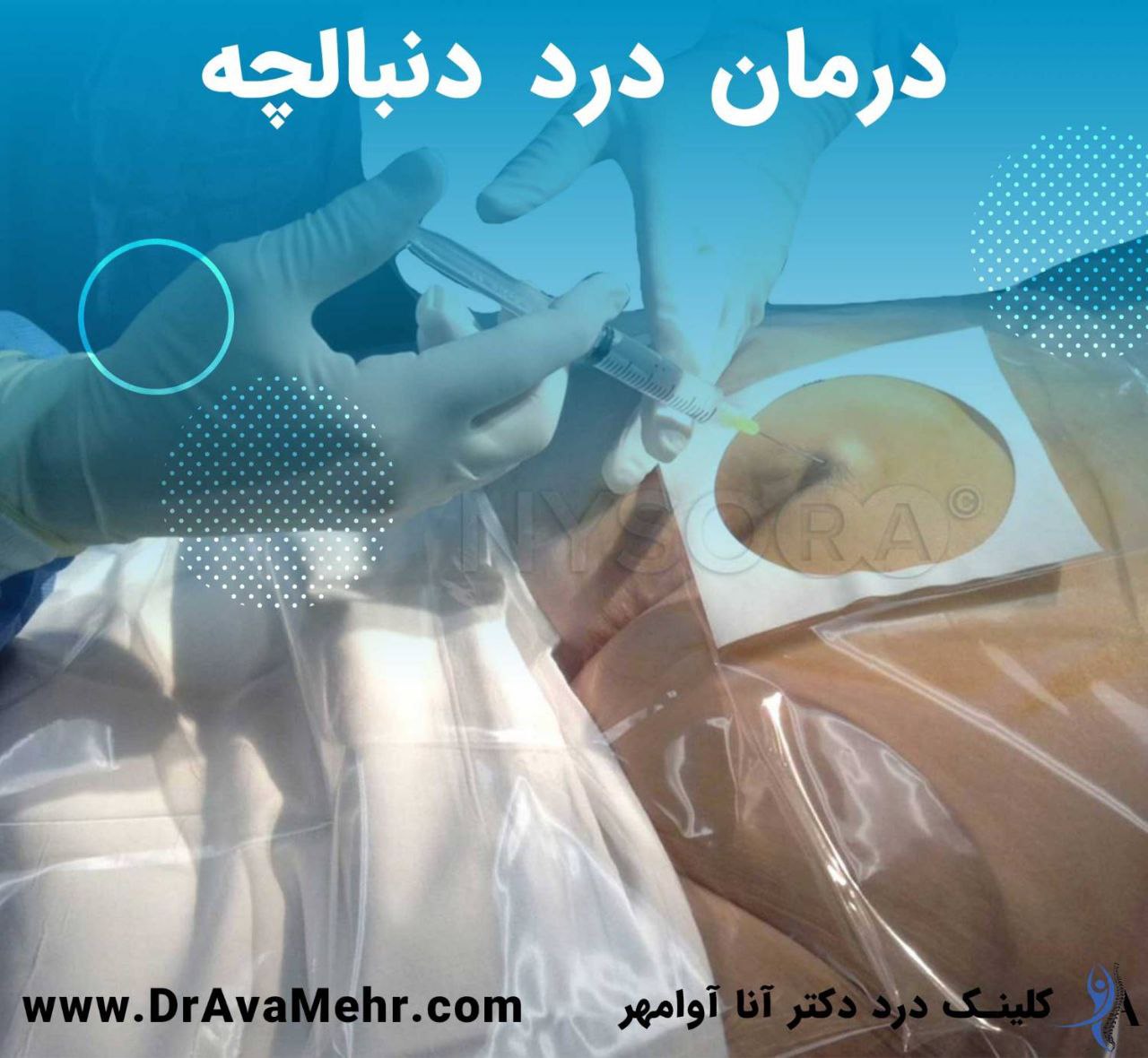 ما هو الذيل؟ سبب الألم وأعراض الخلع وطرق العلاج