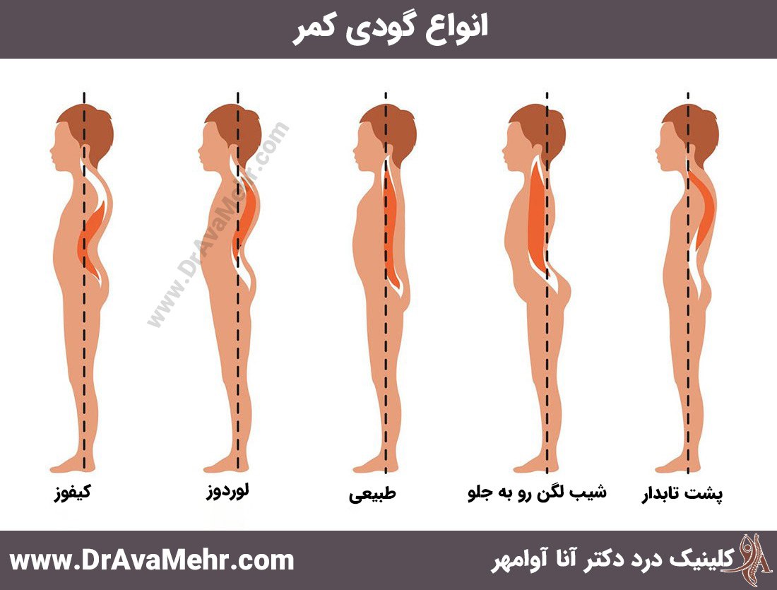 Types of lumbar depression and its treatment - Dr. Anna Avamehr