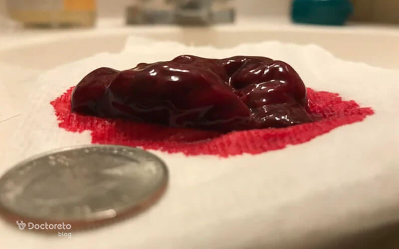 آیا لخته شدن خون در قاعدگی خطرناک است؟