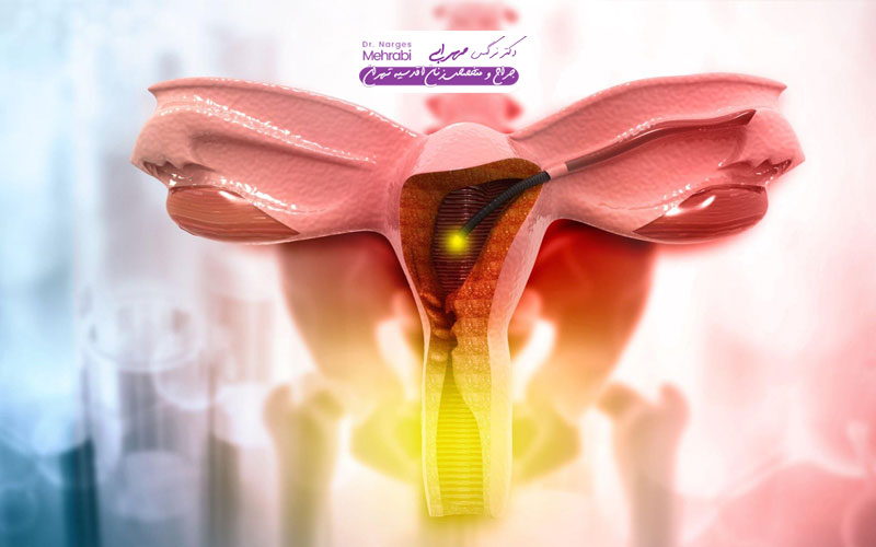 Laparoscopy of the uterus for infertility Dr. Narges Mehrabi