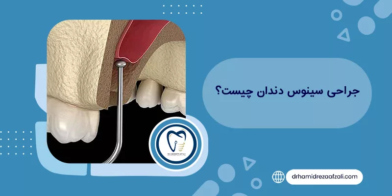ما هي جراحة الجيوب الأنفية للأسنان؟ | دكتور حميدرضا أفضلي