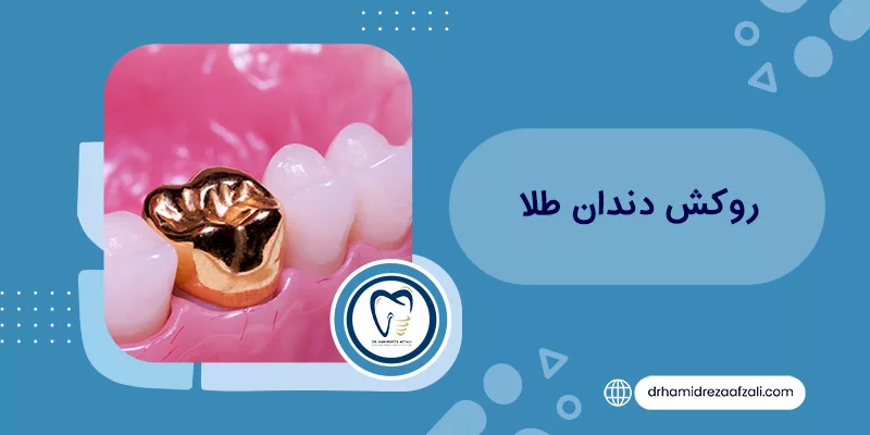 What is a gold crown? Comprehensive introduction + advantages and disadvantages Dr. Afzali