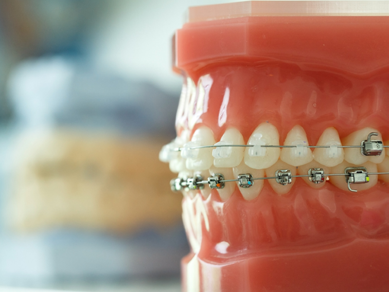 تقويم الأسنان في كرج