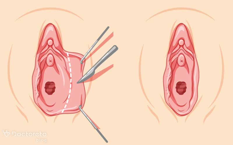 دلیل گوشت اضافی بعد از لابیاپلاستی چیست؟