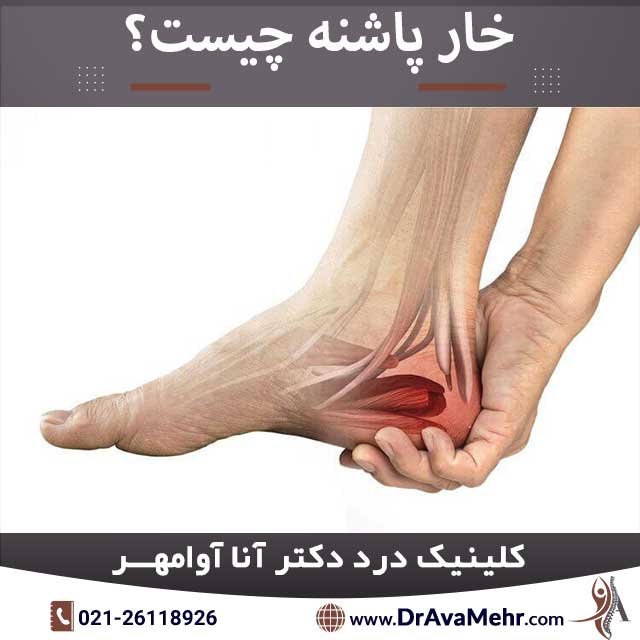 Heel spur - cause, prevention and treatment - Dr. Anna Avamehr