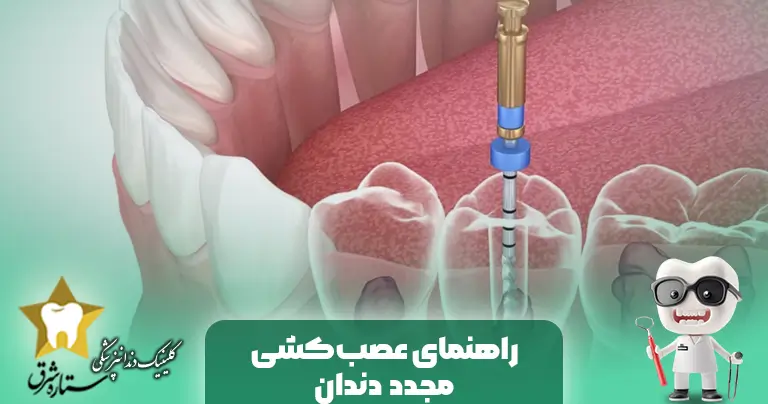 راهنمای کامل عصب کشی مجدد دندان ها (Re-Endo)