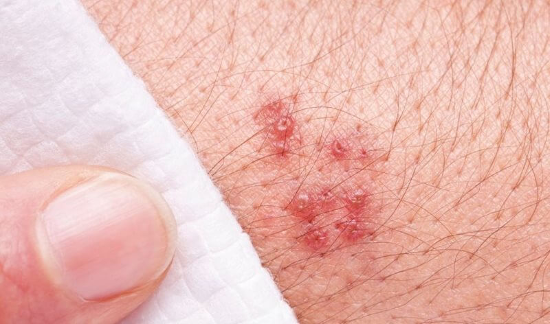 Sexual diseases treatment methods - Jahanshahr urology center