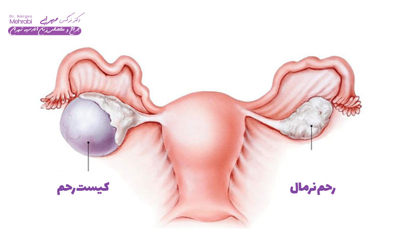 Uterine cyst treatment Dr. Narges Mehrabi