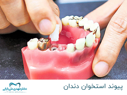 پیوند استخوان دندان - همه چیز در مورد پیوند استخوان دندان