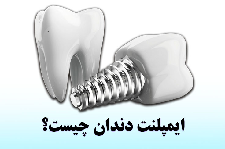 ایمپلنت دندان چیست؟ مزایا، طول عمر + عکس قبل و بعد از ایمپلنت