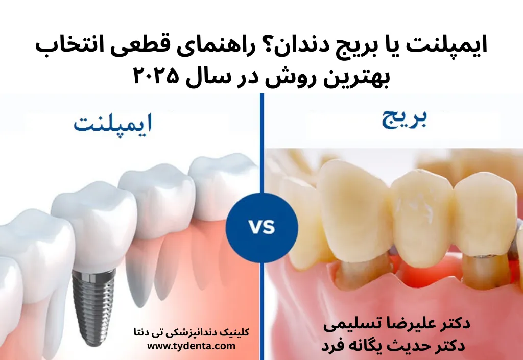 ایمپلنت یا بریج دندان؟ راهنمای انتخاب بهترین روش در سال 2025