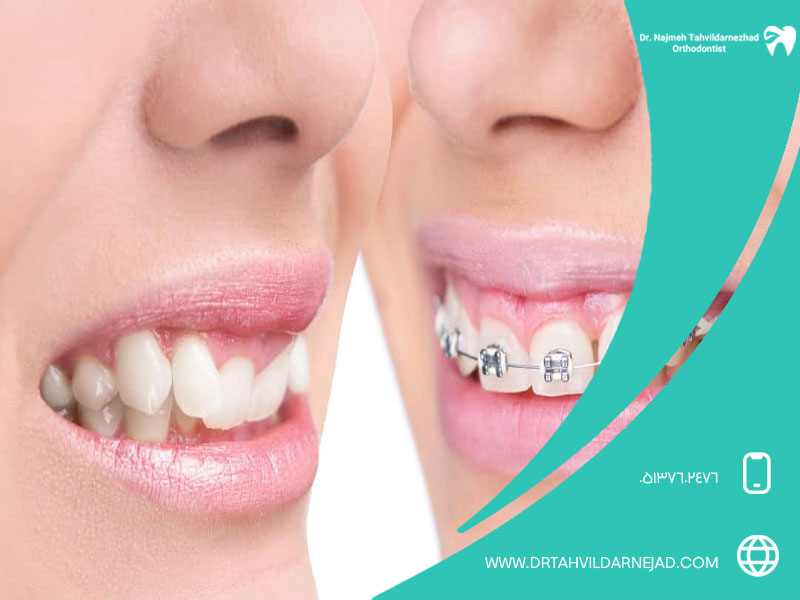 Investigating the effects of orthodontics on the shape of the lips and face Dr. Najmeh Tadredaranjad