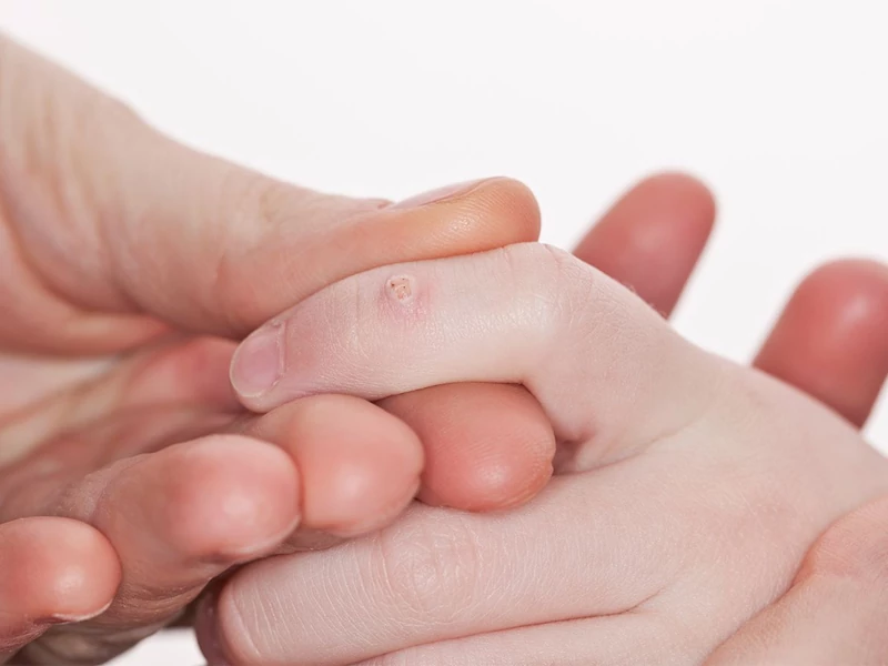 Warts in children - Dr. Ali Faraji