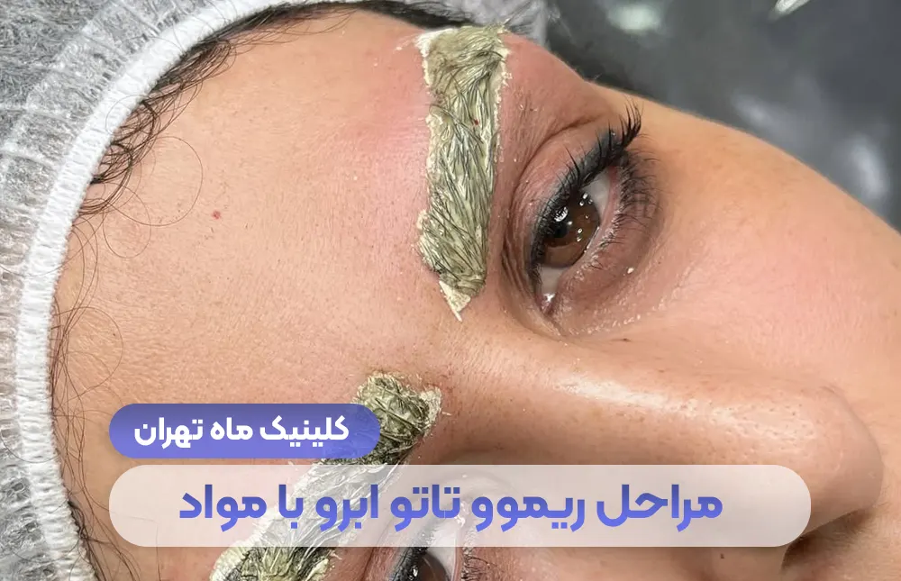 مراحل حذف تاتو ابرو با مواد و هزینه تهران - کلینیک ماه تهران