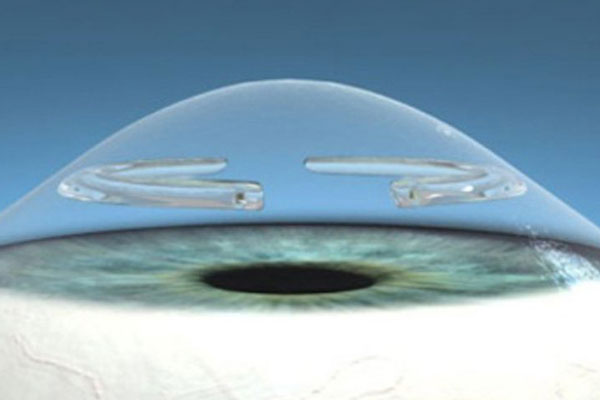 Keratoconus surgery, treatment method and surgical procedures
