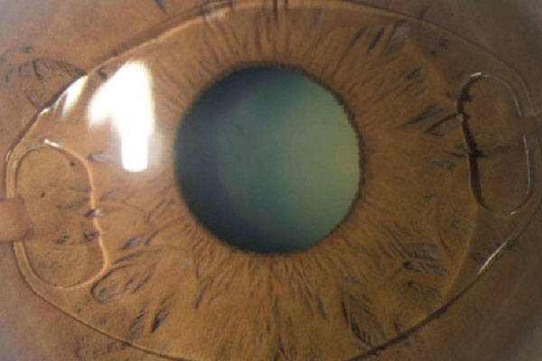 Types of intraocular lenses and their difference with LASIK surgery