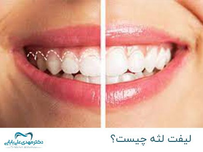 لیفت لثه چیست - لیفت لثه چگونه انجام می شود - افزایش تاج لثه