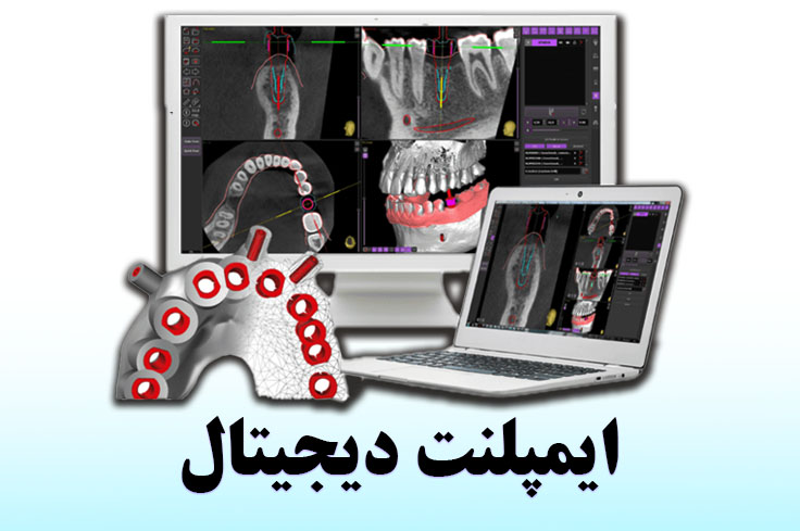 ایمپلنت دیجیتال چیست؟ قیمت ایمپلنت دیجیتال 1404