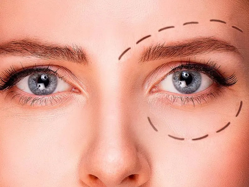 The cost of blepharoplasty in 1404