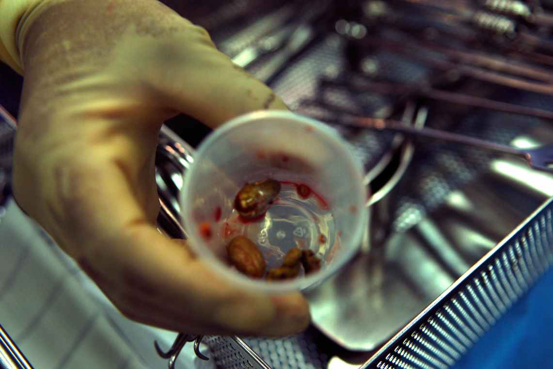 Laser treatment of kidney stones - Jahanshahr Urology Center - 09365634984