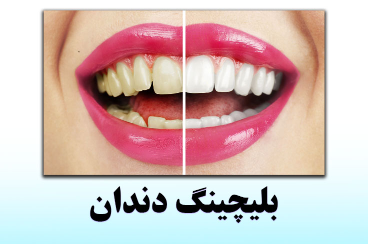 بلیچینگ دندان چیست؟ (هزینه 1404 + ماندگاری و عکس)