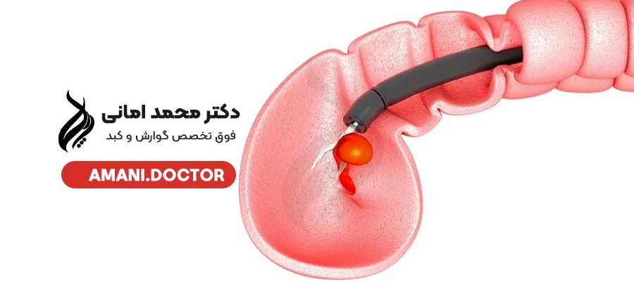 هل السليلة المعوية هي نفسها السرطان؟ - الدكتور محمد أماني أخصائي أمراض الجهاز الهضمي والكبد